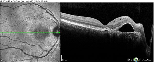 Figure 7: OD Spectralis OCT of the macula at 10 month follow-up showing a large PED between the fovea and disc, with mild overlying intraretinal cystic degeneration. 