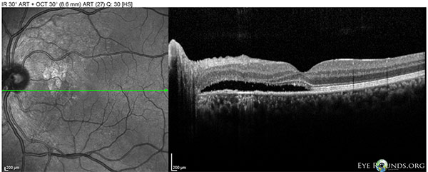 Figure 8: OS Spectralis OCT of the macula at 10 month follow-up showing worse shallow SRF between the nerve and fove