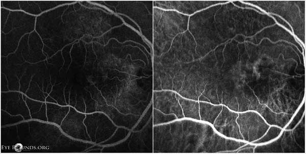 Figure 9: OD FFA (left) and ICG (right) showing punctate fluorescent lesions temporal to the optic nerve in the nasal macula, most consistent with polypoidal lesions. 