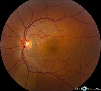 Figure 2: OS color fundus photograph at initial presentation showing SRF temporal to the disc and scattered yellow pigment superonasal to macula.