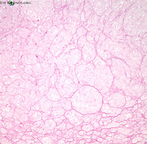 Complex vascular pattern with a large fibrovascular network