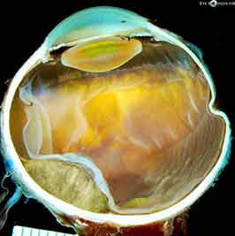 Choroidal malignant melanoma in a "collar button" configuration