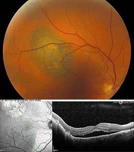 Choroidal malignant melanoma with orange pigment