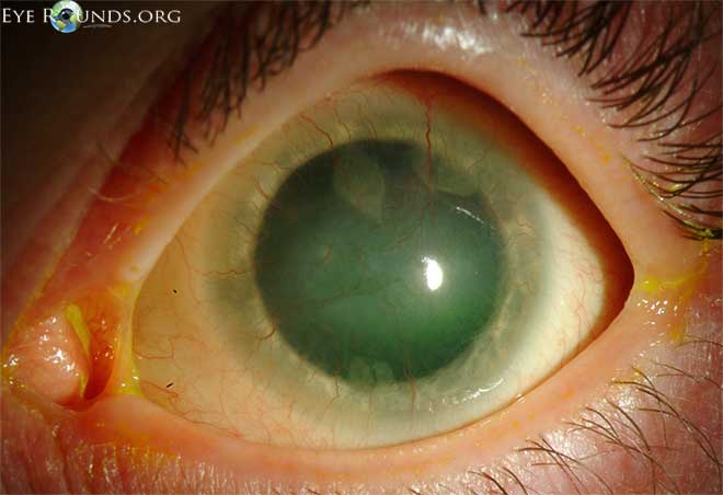 Slit-lamp photograph showing the long-term consequences of SJS/TEN, which can include limbal stem cell deficiency and symblepharon.