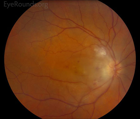 Color Fundus, right eye