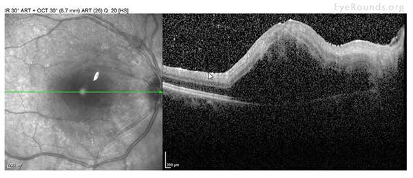 Central macular thickness is 819 microns (320 microns prior) there is a large, foveal-involving, serous retinal detachment.