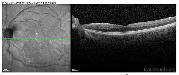 Central macular thickness is 267 (266 microns prior) there is an ERM slight outer retinal segment derangement