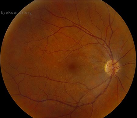 Epiretinal membrane with retinal thickening at the macula, attenuation of the retinal vasculature with resolution of the vasculitis and fluid in the macula.
