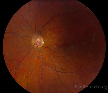 Stable tortuous optociliary shunt vessels in the cup of the disc, mild epiretinal membrane.