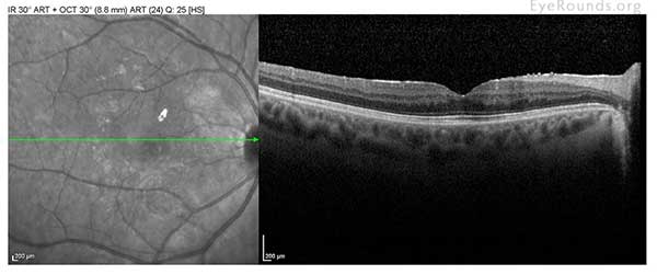 mild ERM; no cystoid macular edema (CME) or sub-retinal fluid (SRF)
