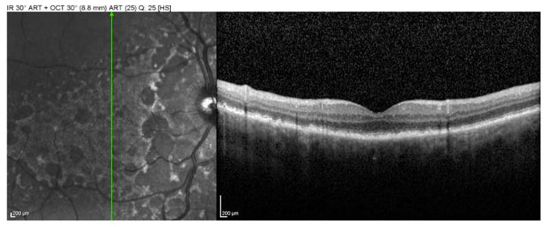 OCT of right eye