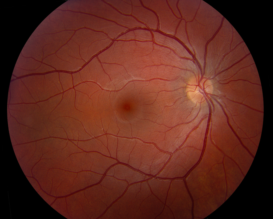 Ocular tilt reaction and skew deviation