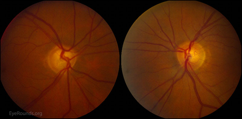 Color fundus photography: There is moderate enlargement of the cup-to-disc ratio OD. 