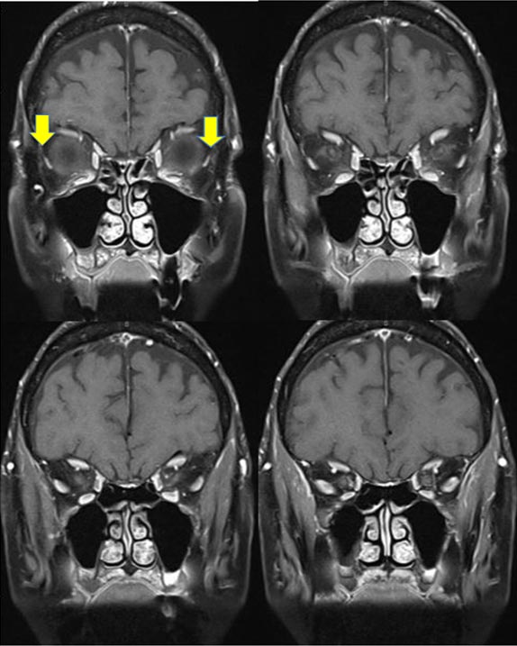 MRI of the orbits with coronal cuts demonstrating inferomedial displacement of the lateral rectus muscles OU (arrows)