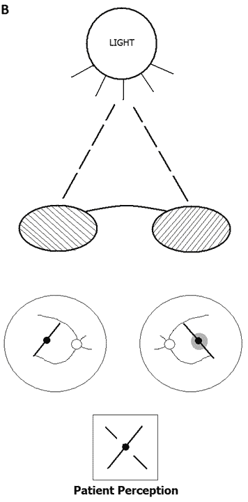 In a patient with monofixation syndrome, the fixating eye (pictured as OD) will perceive a continuous streak of light intersecting the fixation light and the non-fixating eye (pictured as OS) will perceive the streak of light as having a gap in it around fixation that represents the central suppression scotoma in this eye.