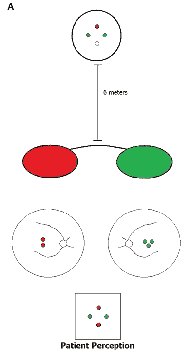 The Worth 4-dot consists of two green lights, one red light, and one white light as seen above. 