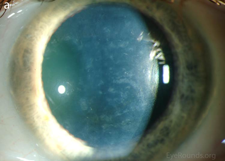 Diffuse inner corneal opacities as seen by direct illumination