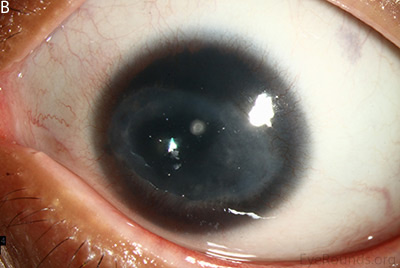 corneal pannus, subepithelial haze, and iris hypoplasia