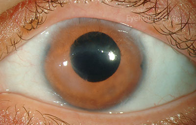 Appearance after cataract extraction and implantation of an Ophtec 311 iris reconstruction intraocular lens with artificial iris.