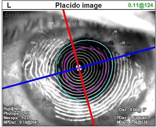 Placido. Paracentral band keratopathy associated with hyperparathyroidism that is inducing irregular astigmatism.