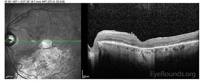 OS: Outer retinal atrophy centrally and inferiorly with trace CME in the superior macula.