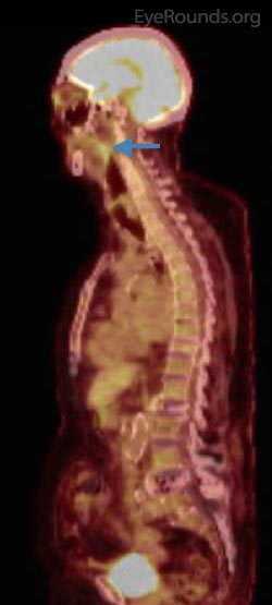 Whole body PET/CT scan showing parotid gland uptake consistent with metastases of the tumor 