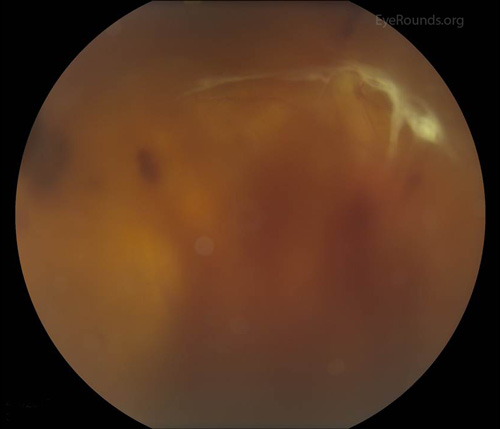 RIGHT EYE. Color fundus photography showing diffuse preretinal hemorrhage preventing a view of the retina bilaterally