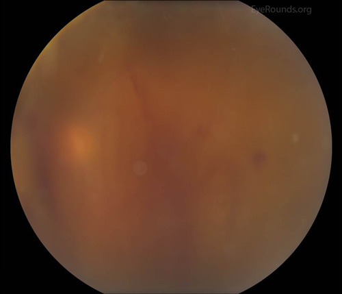LEFT EYE. Color fundus photography showing diffuse preretinal hemorrhage preventing a view of the retina bilaterally