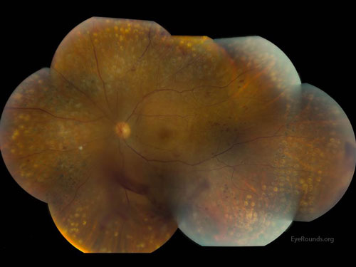Left eye. Areas of preretinal hemorrhage inferiorly, dot blot hemorrhages throughout the periphery in all four quadrants, and moderate panretinal photocoagulation scars diffusely