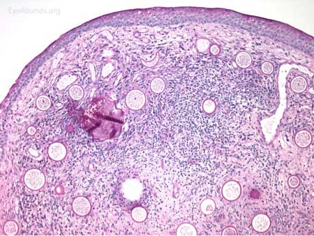 Inflammatory cells surround trophocytes, including neutrophils, lymphocytes, plasma cells, and multinucleated giant cells, often in scattered granulomas. Note there is increased vascularity. 