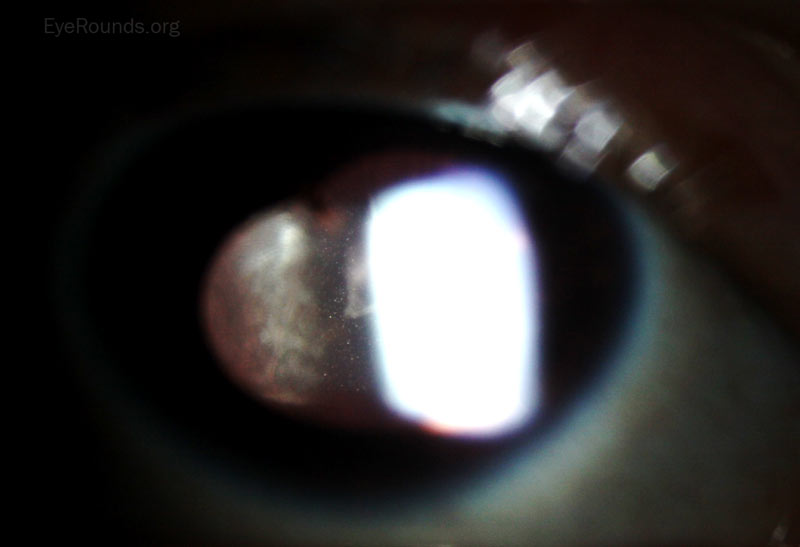 2+ anterior chamber cell in the right eye
