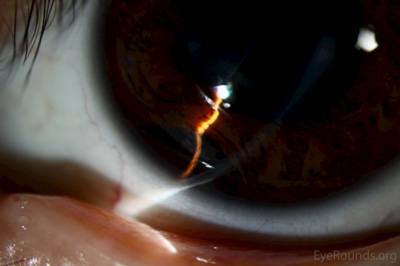 Bottom left:  The slit beam demonstrates the elevation of the lesion relative to the surrounding iris.