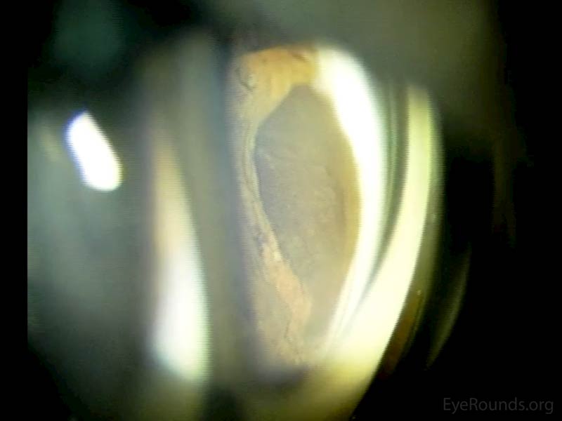 Figure 2:  On gonioscopy, an elevated, dark brown lesion is seen extending from 7 to 8 o'clock without spread into the surrounding trabecular meshwork.
