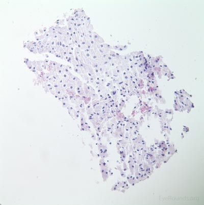 Top right:  Low power photomicrograph of biopsy following application of melanin bleach permits visualization of cellular morphology (Melanin bleach H&E stain, original magnification=100x)