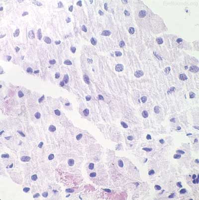 Bottom right:  High power photomicrograph of biopsy tissue following application of melanin bleach reveals the presence of polygonal cells with bland, oval to round nuclei with indistinct nucleoli and abundant cytoplasm consistent with the diagnosis of melanocytoma (Melanin bleach H&E stain, original magnification=300x)