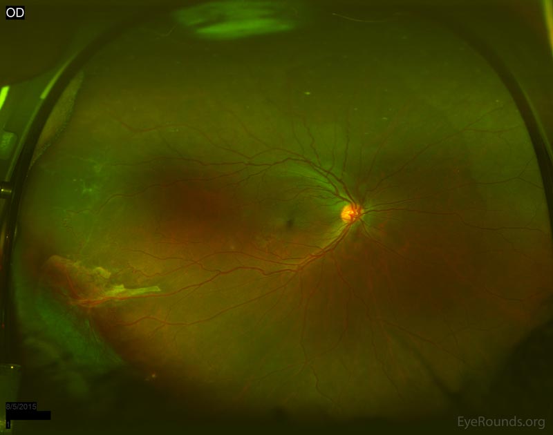 Widefield fundus photo of the right eye demonstrating white membranes and NVE in the far temporal periphery. Tractional membrane inferotemporally from 7:00 clockwise to 9:00 with old neovascular tufts. White without pressure from 12:00 to 5:30 in the mid-periphery.
