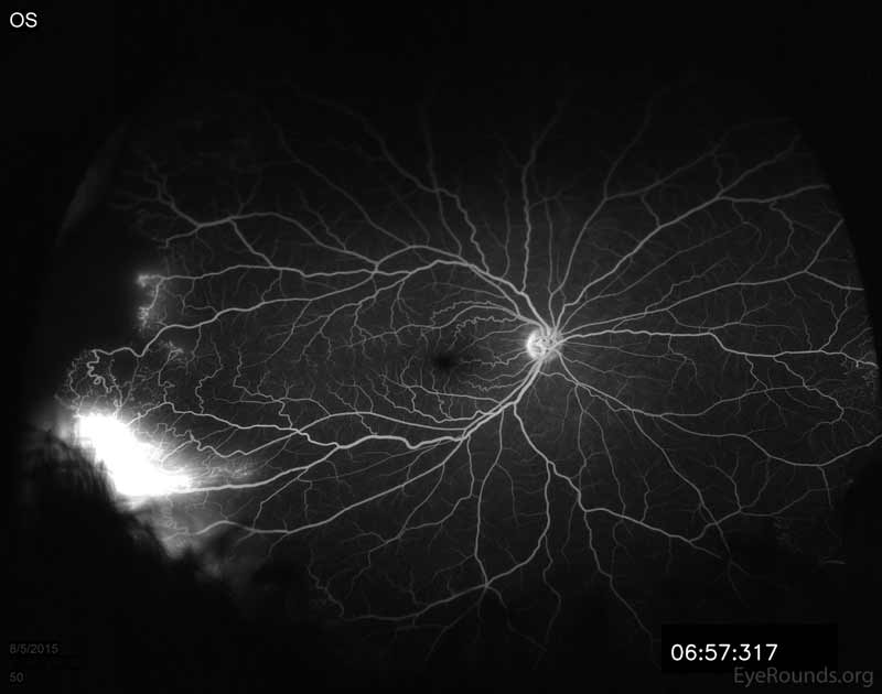 Fluorescein angiogram of the right eye demonstrating NVE at 9:00 with marked late leakage inferotemporally in the area of retinal neovascularization.