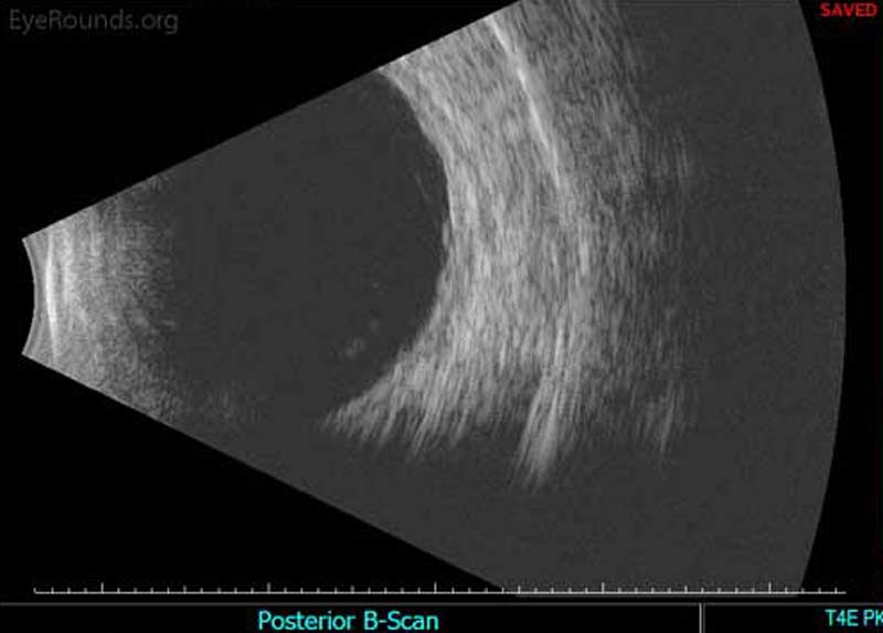 Figure 4C: The tractional membrane seen inferotemporally near the equator is associated with minimal thickening of the retina, but a retinal detachment is not present.