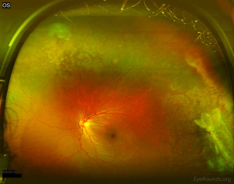 Acute scatter photocoagulation edema spots can be seen in the areas of retinal capillary non-perfusion. Care was taken to avoid areas of traction in the left eye.