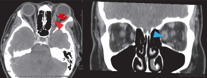 CT of the orbits without contrast: The axial image on the left demonstrates enlargement of the left medial rectus muscle, including the tendon (red arrowhead) with adjacent fat stranding (red arrows). The coronal image on the right demonstrates enlargement of the left medial rectus (blue arrow) in comparison to the right medial rectus. Note the absence of sinus disease, retro-orbital mass, or enlargement of the lacrimal gland. 