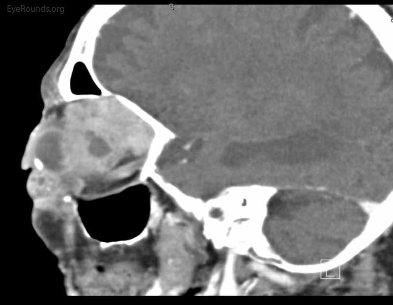 Coronal, frontal, and sagittal views from CT maxillofacial with contrast at the time of follow-up, The CT demonstrates massive interval growth of the left orbital mass displaying both solid enhancing and cystic components. The epicenter of the mass appears to be in the left lacrimal gland There is marked left proptosis with compression and deformation of the left globe as well as medial displacement of the optic nerve and extraocular muscles. There is no definite sign of osteolysis of the orbital walls, however, there is bone remodeling with depression of the orbital floor. No evidence of intracranial extension of the left orbital mass.