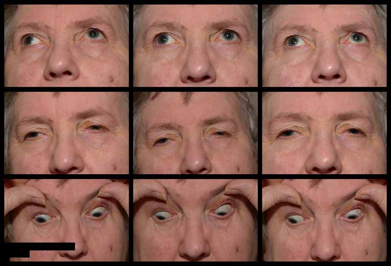 Color photos of extraocular motility. In primary gaze, there is a moderate right exotropia. The left eye cannot adduct or abduct, resulting in complete left horizontal gaze palsy. The right eye cannot adduct.  Motility does not change with Doll's head maneuvers. No supraduction or infraduction deficits present. 