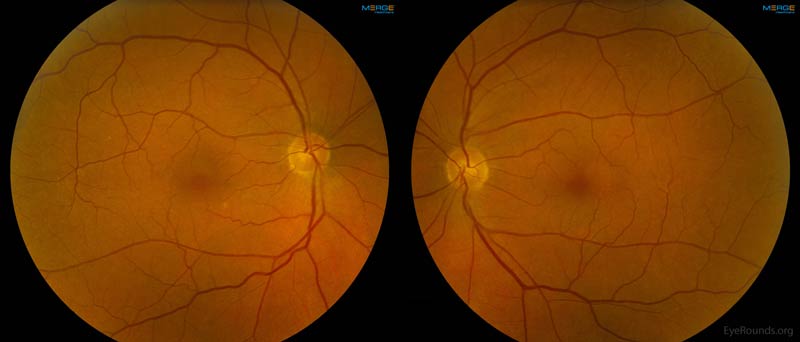 Color fundus photographs of both eyes as detailed in the above DFE.