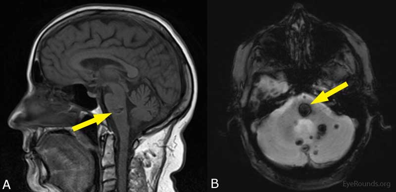 MRI of the brain showing multiple cavernomas that can be described as having a "popcorn" appearance. A) T1-weighted sagittal view showing brainstem involvement. B) Gradient axial view. The yellow arrow in both images shows the likely etiologic lesion which is 14 x 13 x 6mm.  Similar lesions were seen throughout the brainstem and cerebrum.
