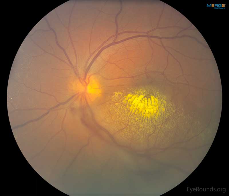 Right Eye, Color fundus photo from day of presentation. There was a hazy view due to vitreous hemorrhage. There were lipid exudates in the central and inferior macula. There were no light-bulb lesions in the macula.