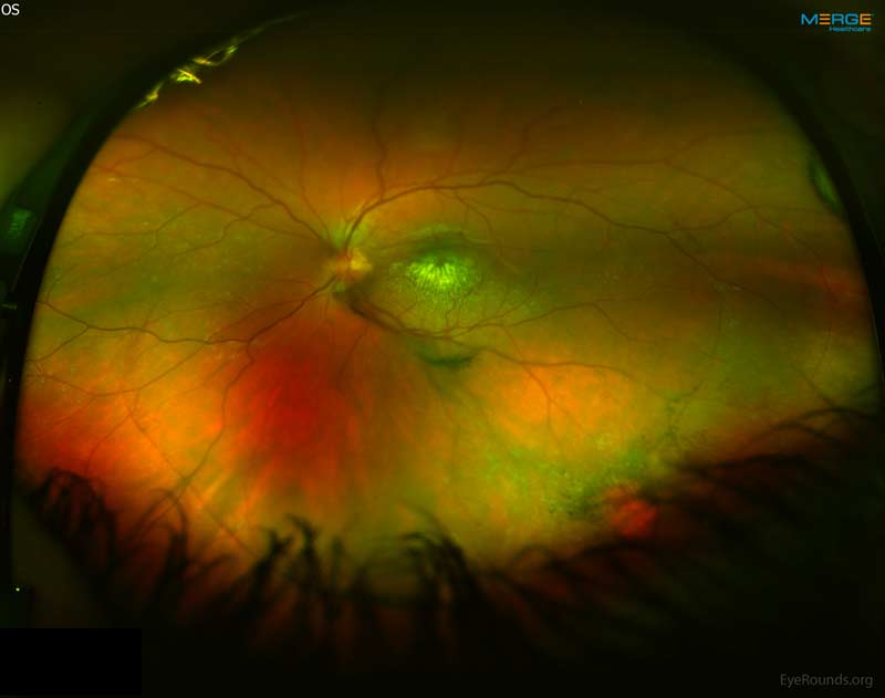Right Eye, Wide-field color fundus photo from day of presentation. Telangiectatic vessels with exudates and light bulb lesions were seen at 4:30 in the far periphery. 