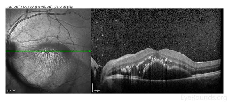 Left Eye, Optical coherence tomography (OCT) of the macula. There is a neurosensory detachment of the macula with lipid exudation and vitreous opacities. 