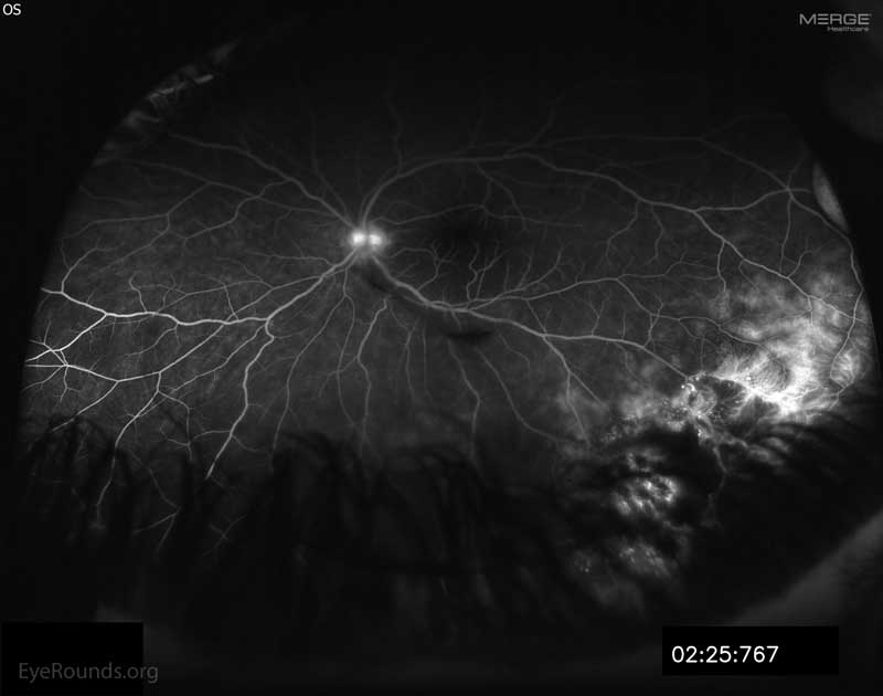 Left Eye, Late phase fluorescein angiography (FA) showing disc hyperfluorescence and late leakage of telangiectatic vessels.