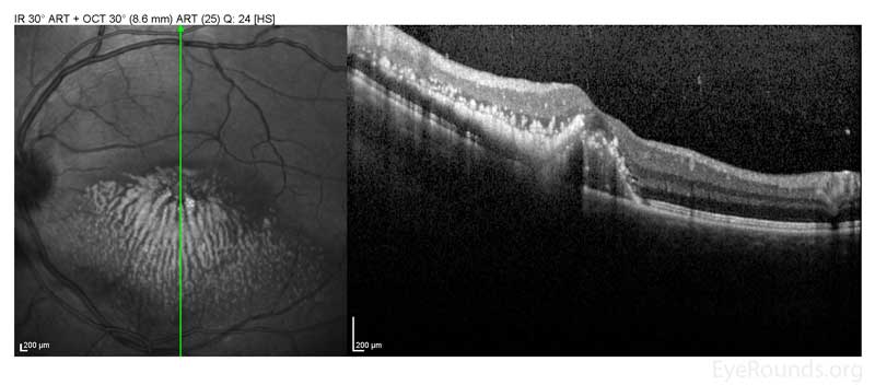 Left Eye, OCT of the macula 5 months after presentation showing improved macular edema after intravitreal bevacizumab.