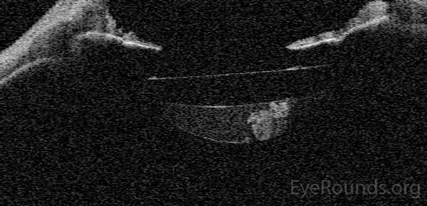 An anterior segment optical coherence tomography (AS-OCT) of the right eye demonstrates late capsular block pre-YAG capsulotomy